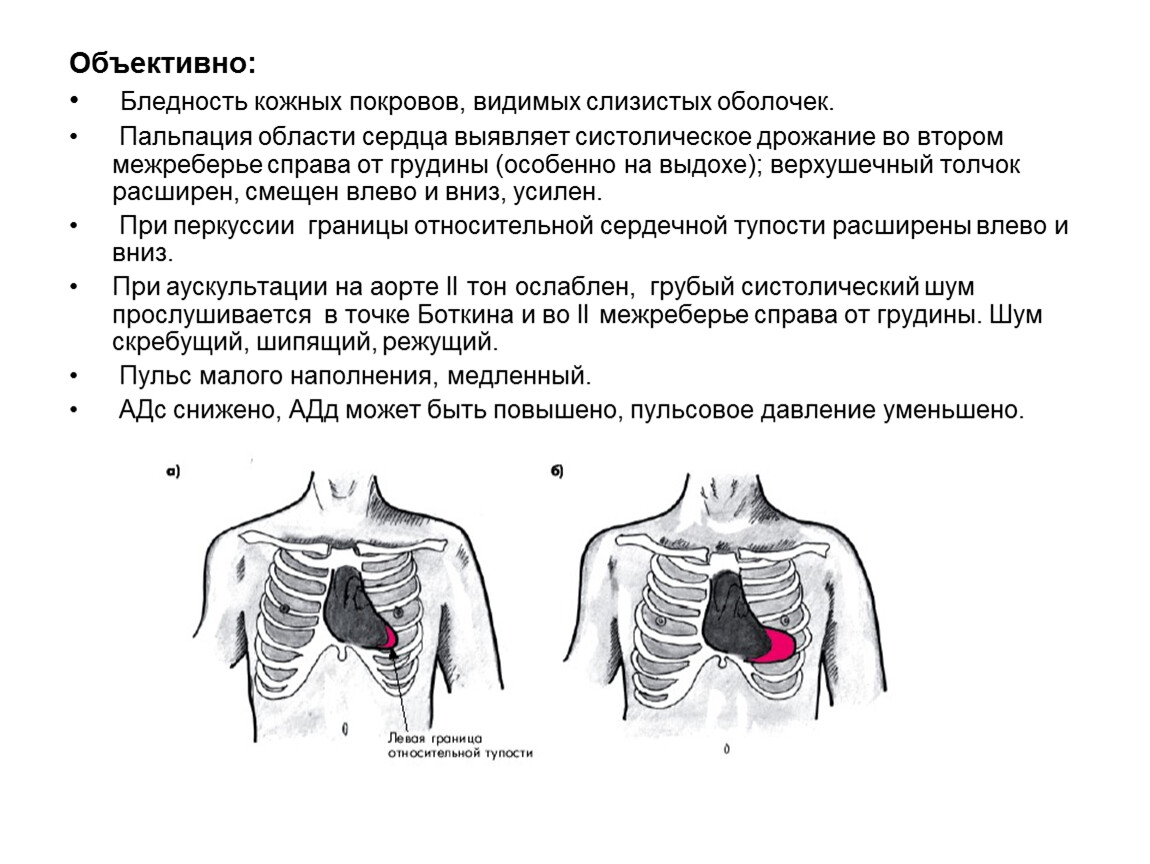 Левый объективный. Ревматизм аускультация. Систолическое дрожание во 2 межреберье справа от грудины. Пальпация во 2 межреберье. Ревматизм аускультация сердца.