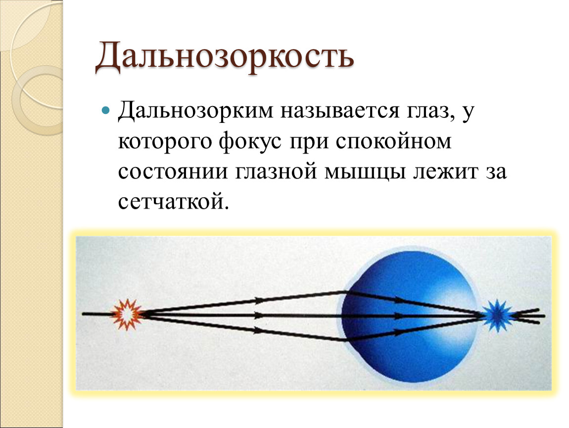 Дальнозорким людям необходимо использовать очки так как у них изображение фокусируется за сетчаткой