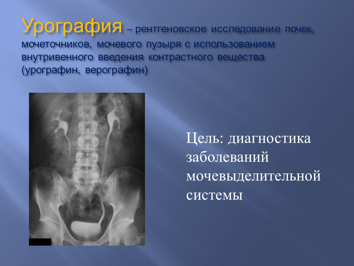 Исследование почек. Внутривенная урография контрастное вещество. Контраст для внутривенной урографии. Рентген исследование почек. Рентгеноконтрастное исследование почек.