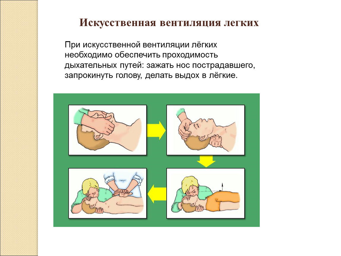 Искусственная вентиляция легких тесты с ответами. Искусственная вентиляция. Искусственная вентиляция легких. Искусственная вентиляция легких (ИВЛ).