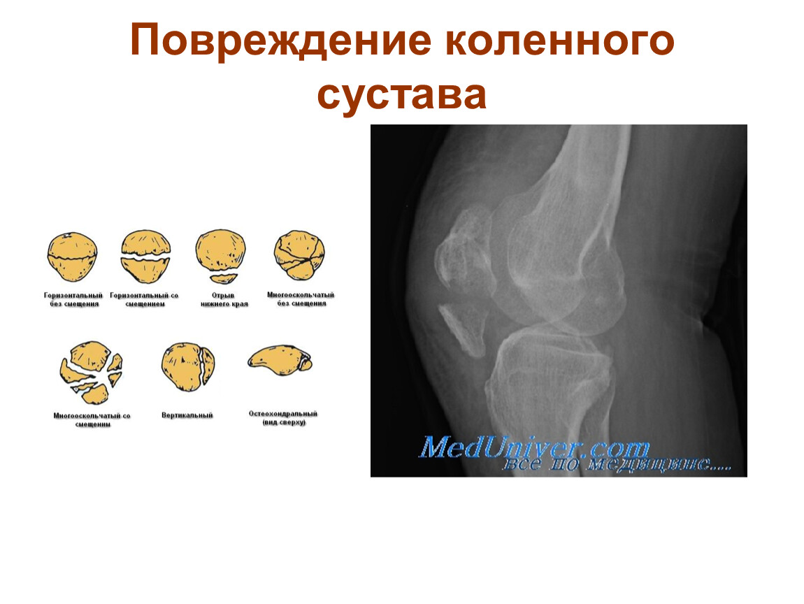 Травма коленного сустава. Повреждение коленного сустава. Классификация травм суставов. Травмы коленного сустава классификация. Классификация повреждений коленного сустава.