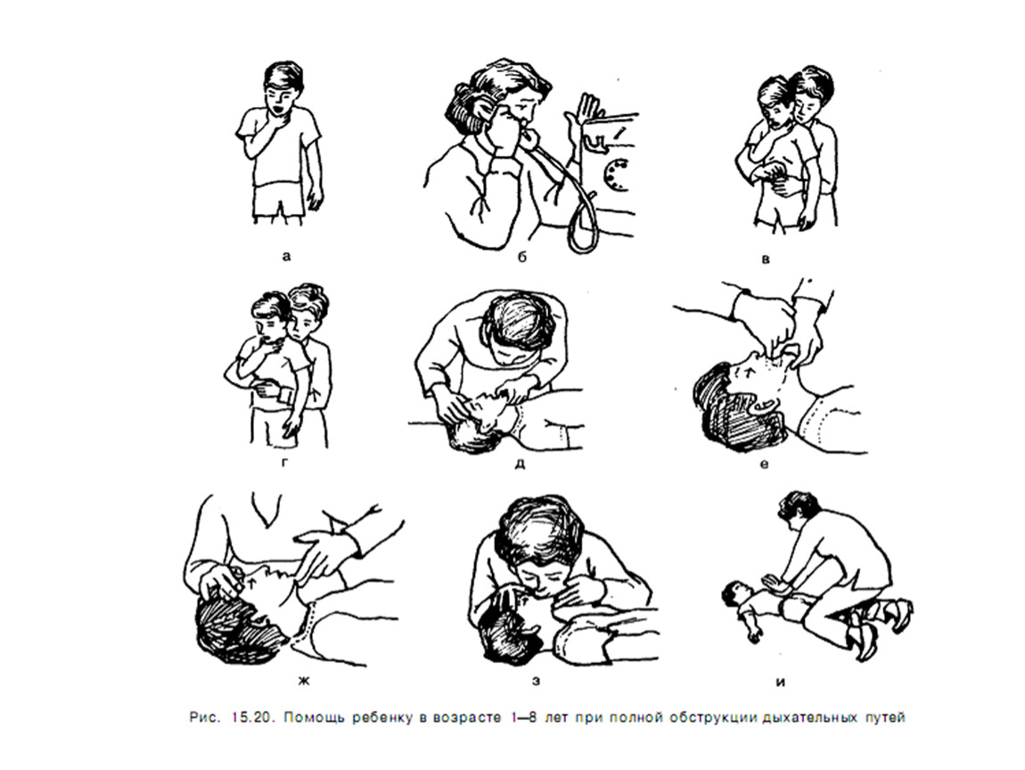 1 1 помощь ребенку. Первая помощь при нарушении дыхательных путей. Первая помощь при обструкции дыхательных путей. Оказание первой неотложной помощи при нарушении дыхания. Первая помощь при полной обструкции дыхательных путей.