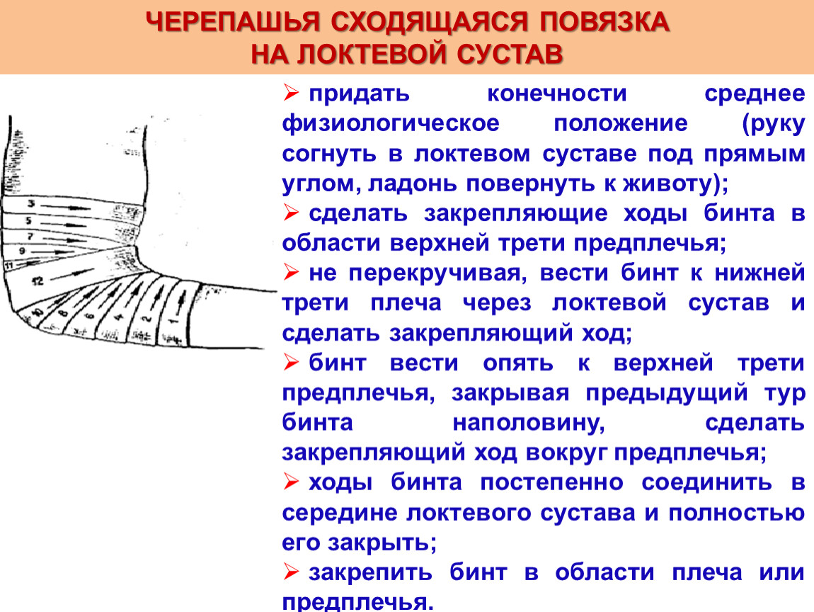ЧЕРЕПАШЬЯ СХОДЯЩАЯСЯ ПОВЯЗКА НА
