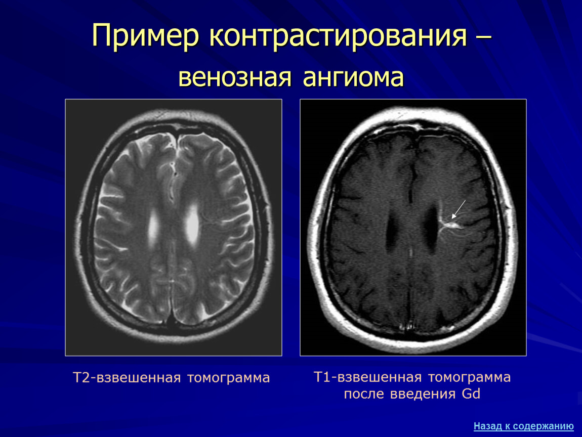 Ангиома правой лобной. Венозная дисплазия головного мозга кт. Венозная ангиома головного мозга кт. Венозная ангиома головного мозга мрт.
