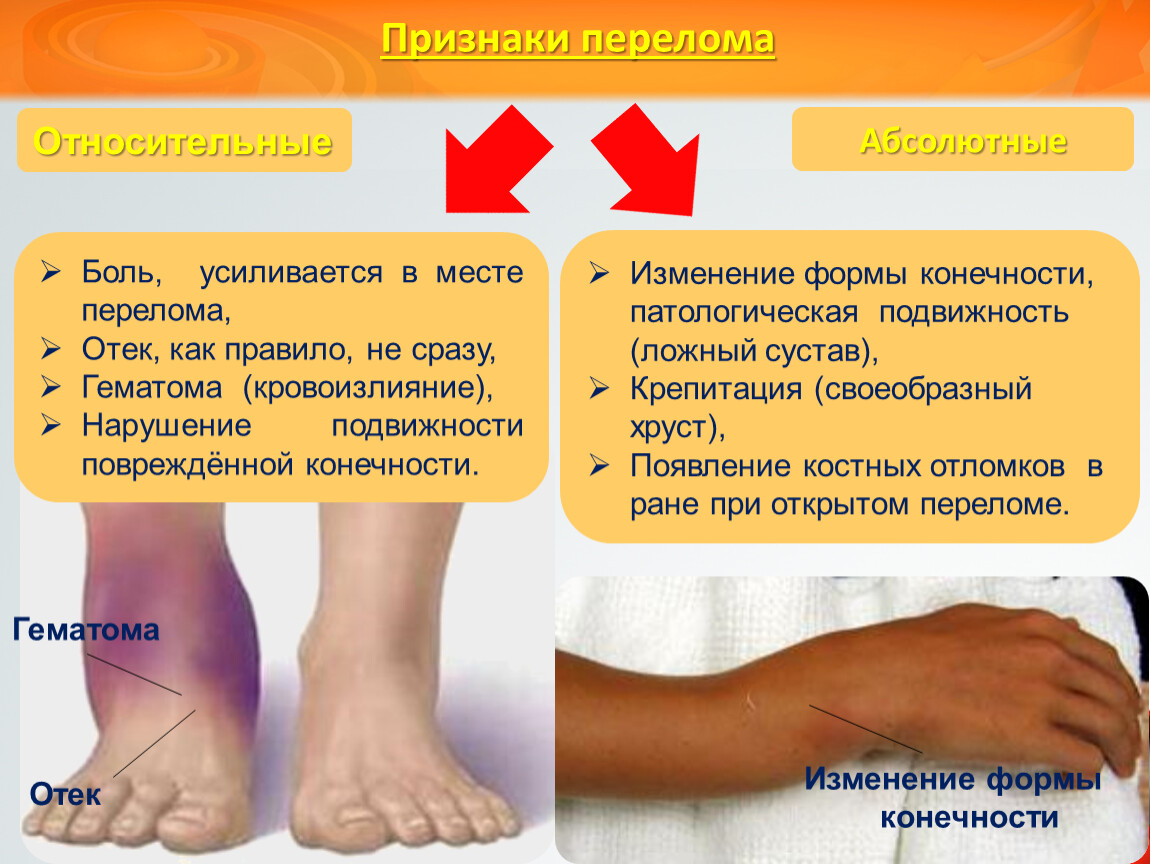 Покалывает левая нога. Хруст в месте перелома.