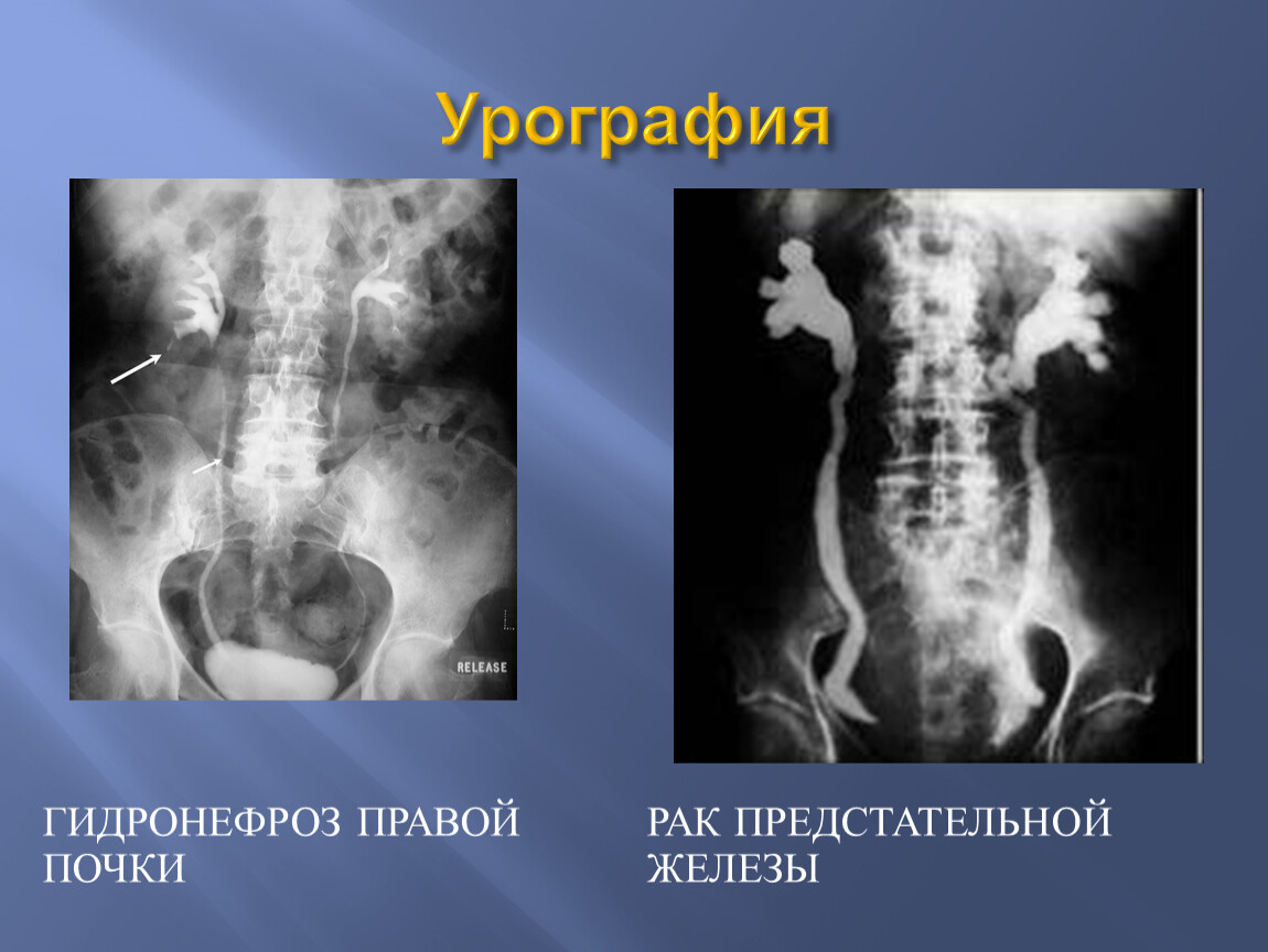 Урография. Экскреторная урография гидронефроз. Гидронефроз почки обзорная урография. Внутривенная урография гидронефроз. Экскреторная урография почек гидронефроз.