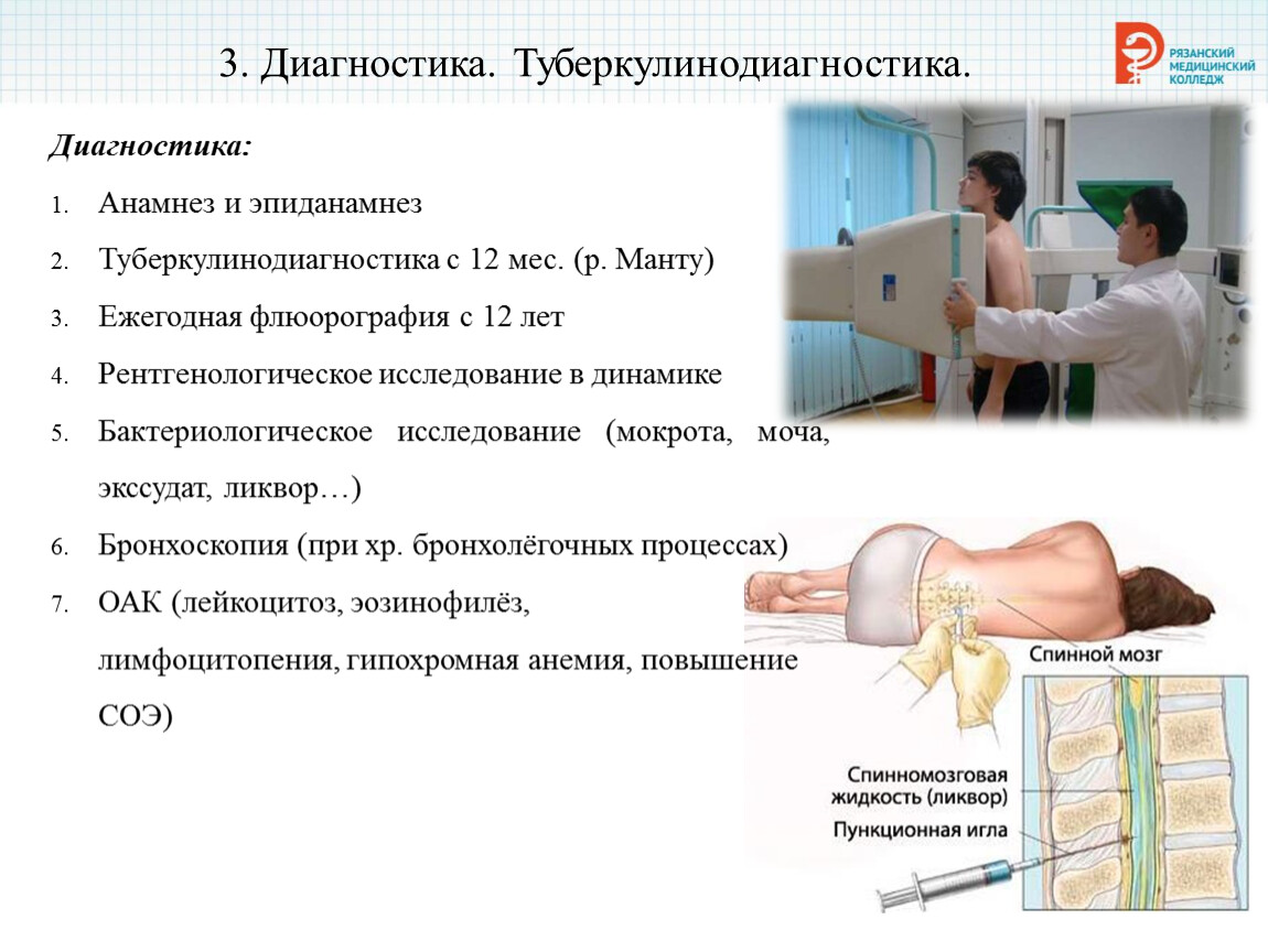 Туберкулинодиагностика фтизиатрия презентация