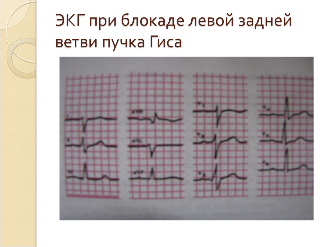 Блокада левой ветви пучка гиса. Лечение при блокаде левой стенке.