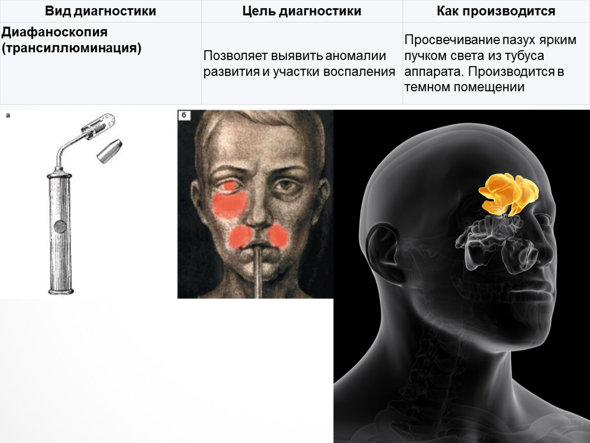 Фронтит осложнения