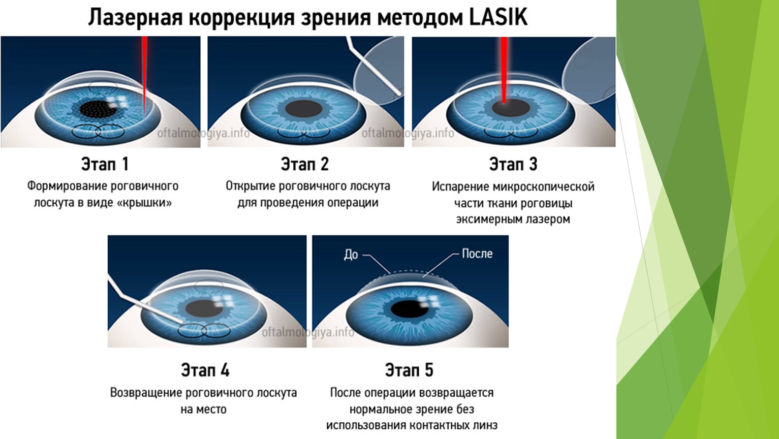 Лазерная коррекция методом Фемто ласик