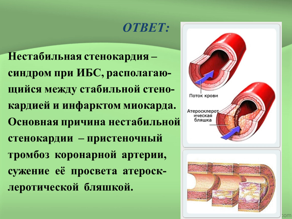 Стабильной стенокардии презентация