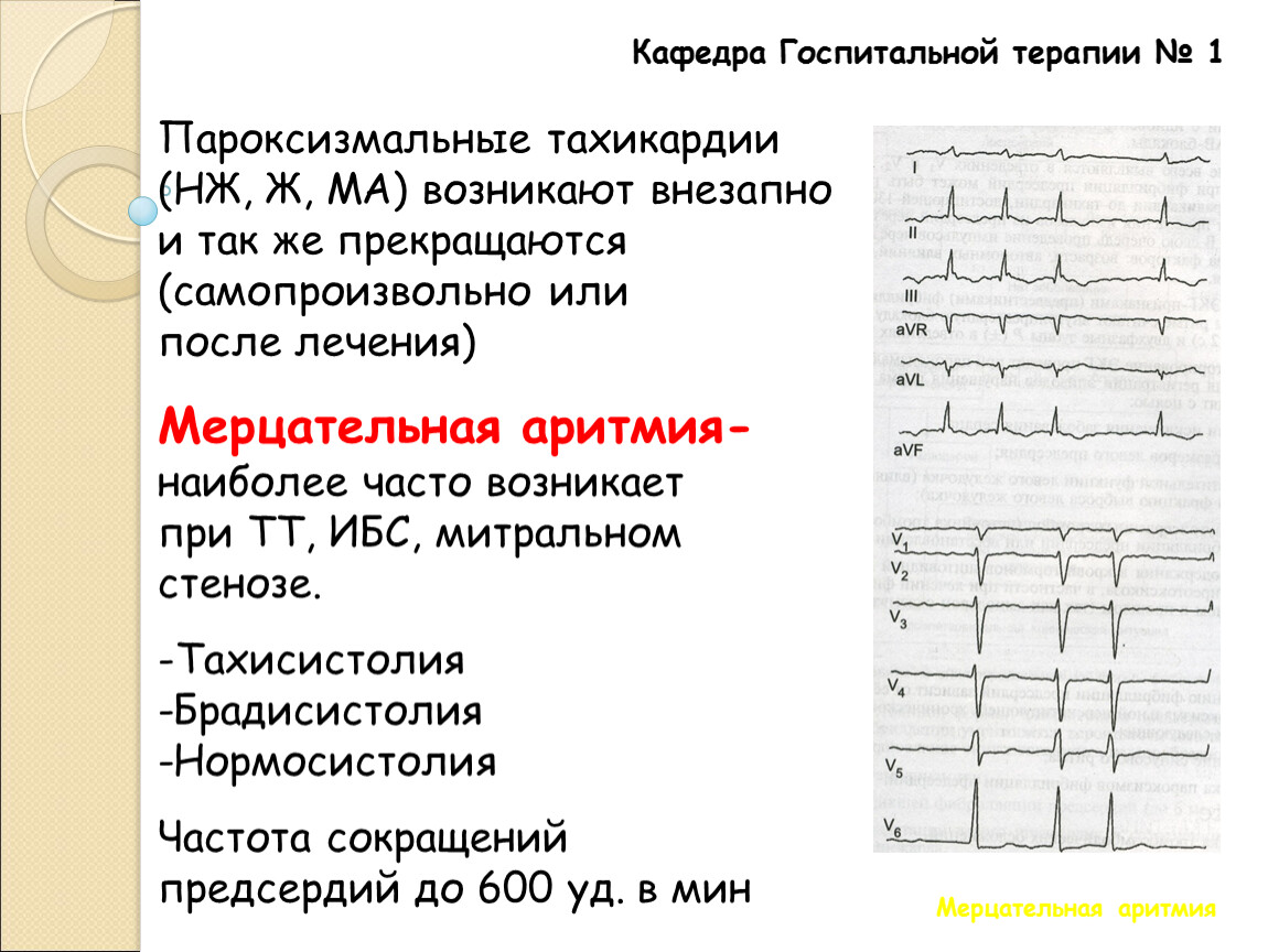 Ибс пароксизмальная форма фибрилляции предсердий карта вызова