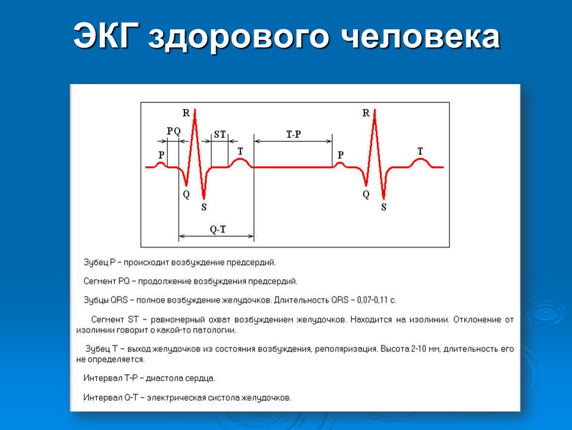 Экг 22. Схема ЭКГ здорового человека. ЭКГ заболевания сердца с расшифровкой. Рисунок расшифровка электрокардиограммы. Как выглядит ЭКГ здорового человека.