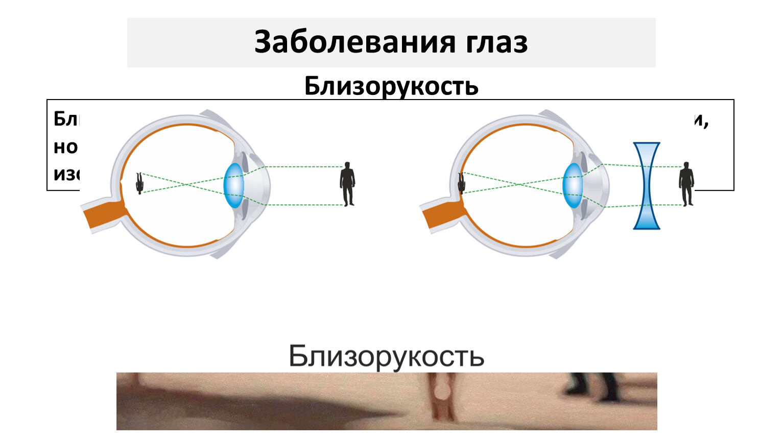 Где фокусируется изображение при близорукости. У близоруких людей изображение фокусируется. Фокусировка изображения у людей с нормальным зрением. Нормальное зрение у человека. В какой части глаза фокусируется изображение у близорукого.