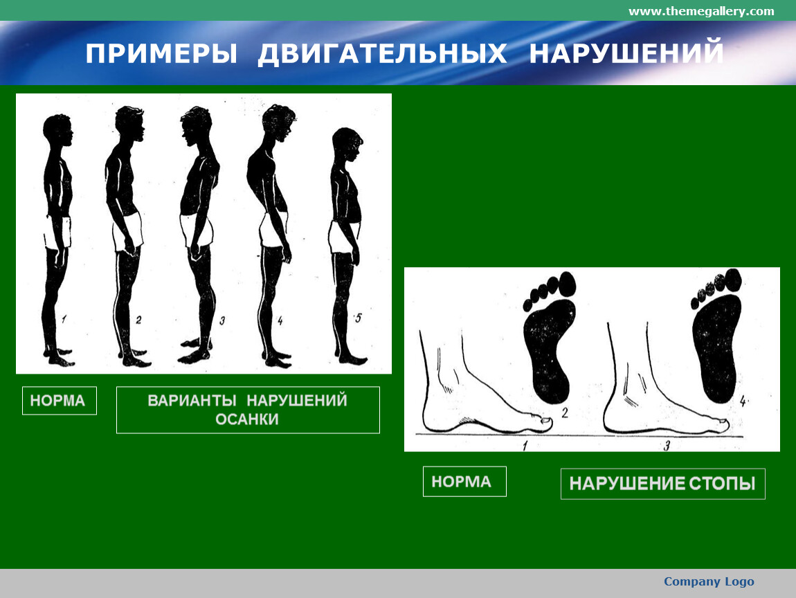 Основные двигательные нарушения. Нарушение опорно-двигательного аппарата нарушение осанки. Примеры двигательных нарушений. Синдром нарушения двигательных функций. Синдромы двигательных нарушений презентация.