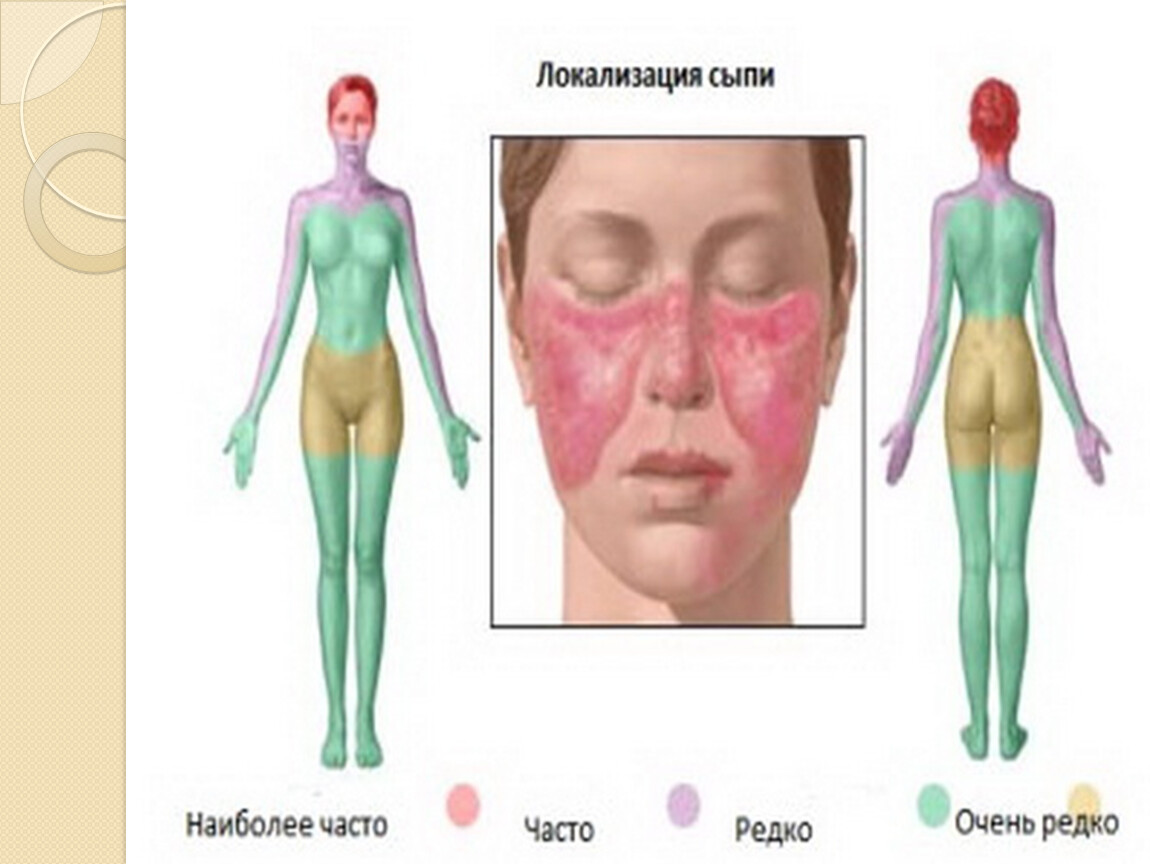 Наиболее частой локализацией. Системная красная волчанка это аутоиммунное заболевание. Аутоиммунное заболевание: системная волчанка.