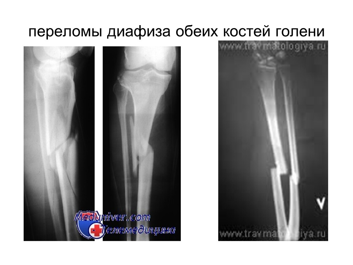 Диафизарные переломы костей голени презентация