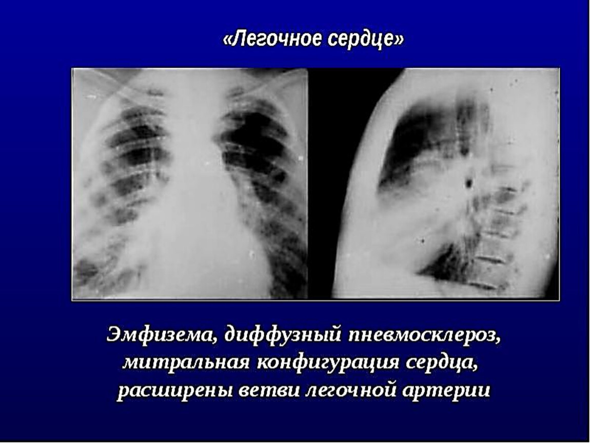 Диффузный пневмосклероз это рак. Хроническое легочное сердце рентген. Легочное сердце на рентгенограмме. Рентгенография при легочном сердце. Легочная конфигурация сердца.