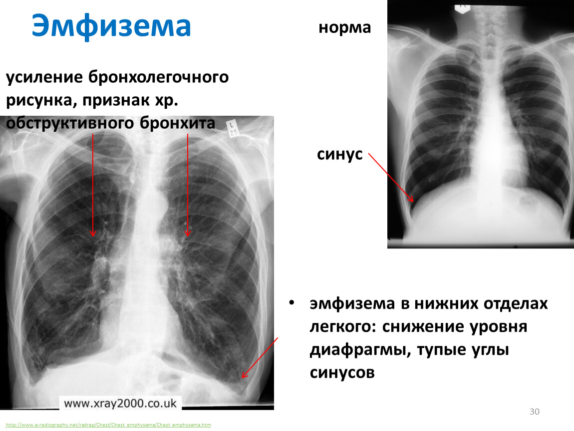 Синусы легких свободны. Эмфизема легких рентген. Плевральные синусы на рентгене. Плеврит в реберно-диафрагмальном синусе рентген. Эмфизема лёгких симптомы рентген.