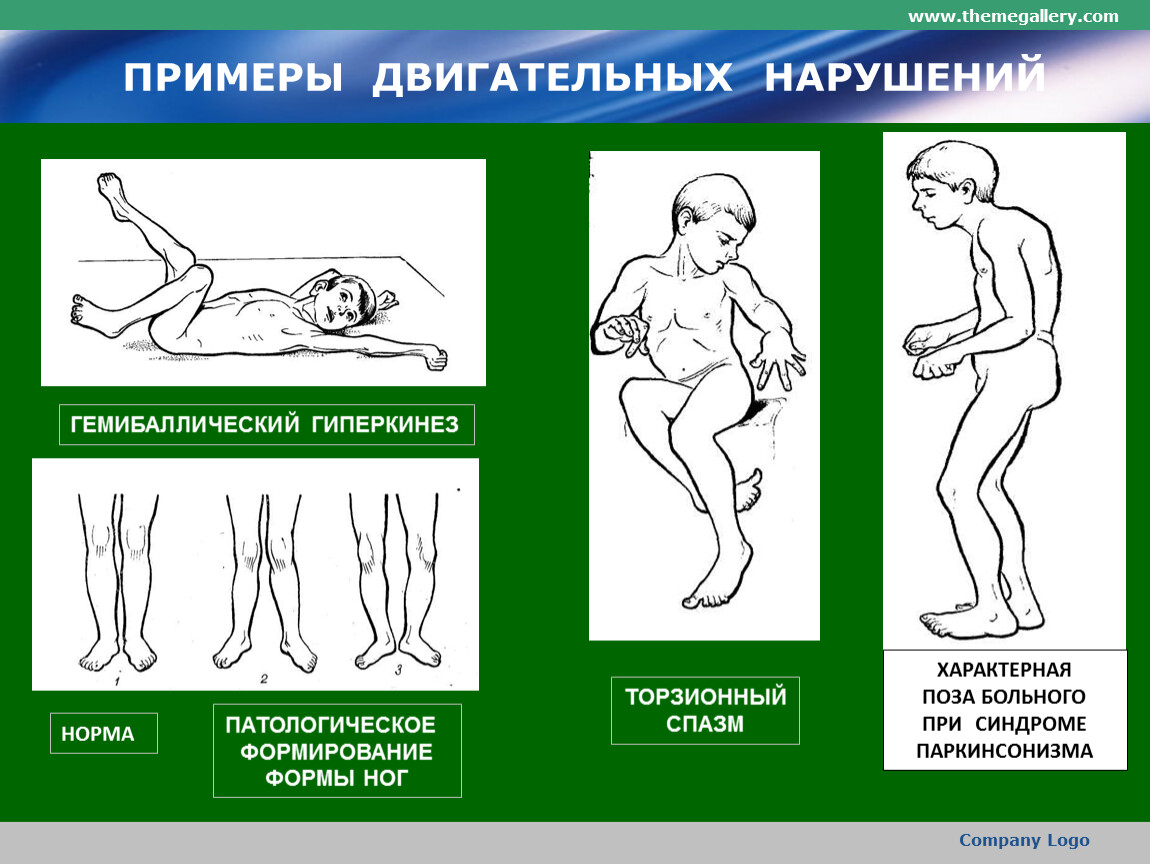 Синдром опорно двигательного аппарата. Синдром двигательных нарушений. Синдром двигательных нарушений у детей. Патологические позы при ДЦП. Двигательные расстройства при ДЦП.