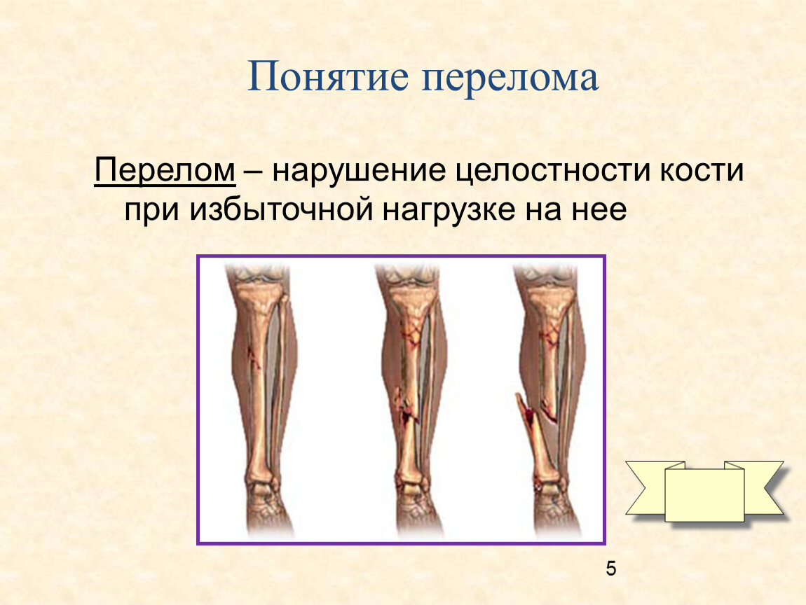Типы закрытых переломов. Классификация переломов костей конечностей. Переломы по степени нарушения целостности кости. Перелом открытый понятие.
