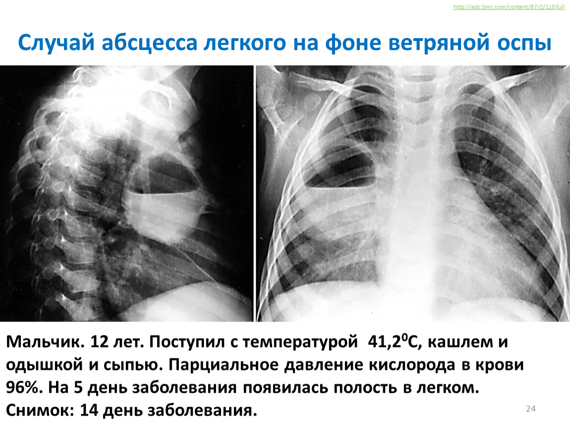 Полость в легком. Абсцесс легкого рентген. Дренирующий абсцесс легкого рентген. Горизонтальный уровень жидкости в абсцессе. Рентген при абсцессе легкого.