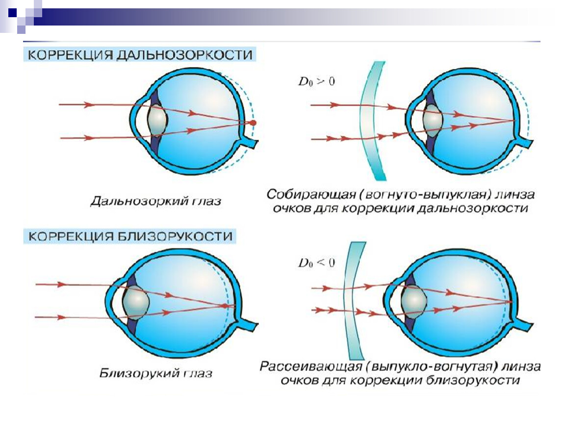 Дальнозоркость линзы двояковыпуклые. Строение глаза дальнозоркость с линзой. Коррекцию дальнозоркости проводят с помощью линз. Оптика глаза схема аккомодация. Линзы дальнозоркость и астигматизм.