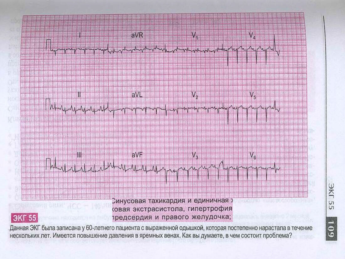 Тахикардия на экг. ЭКГ синусовая тахикардия заключение. Синусовая тахикардия на ЭКГ. Тахикардия сердца на ЭКГ.