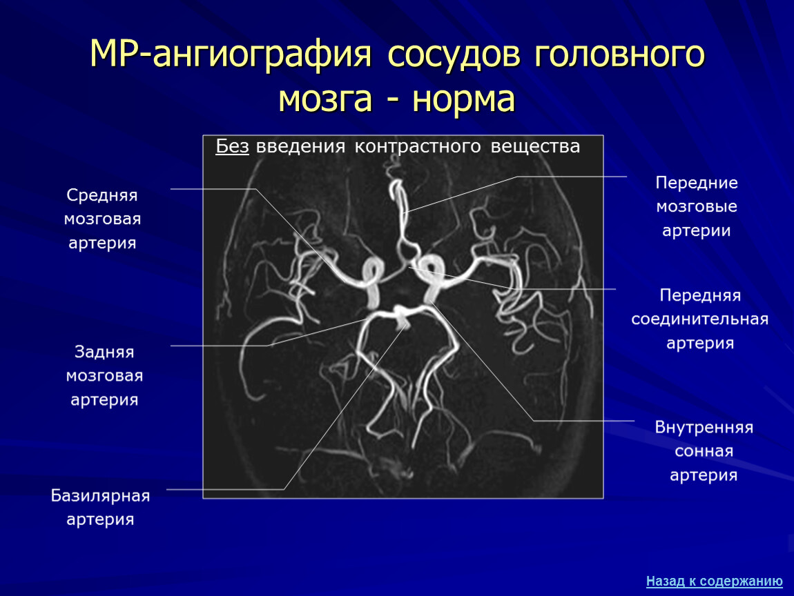 Артерии задних сегментов. Передняя соединительная артерия головного мозга кт. Артерии головного мозга СКТ. Анатомия средней мозговой артерии на кт. Задняя мозговая артерия кт.