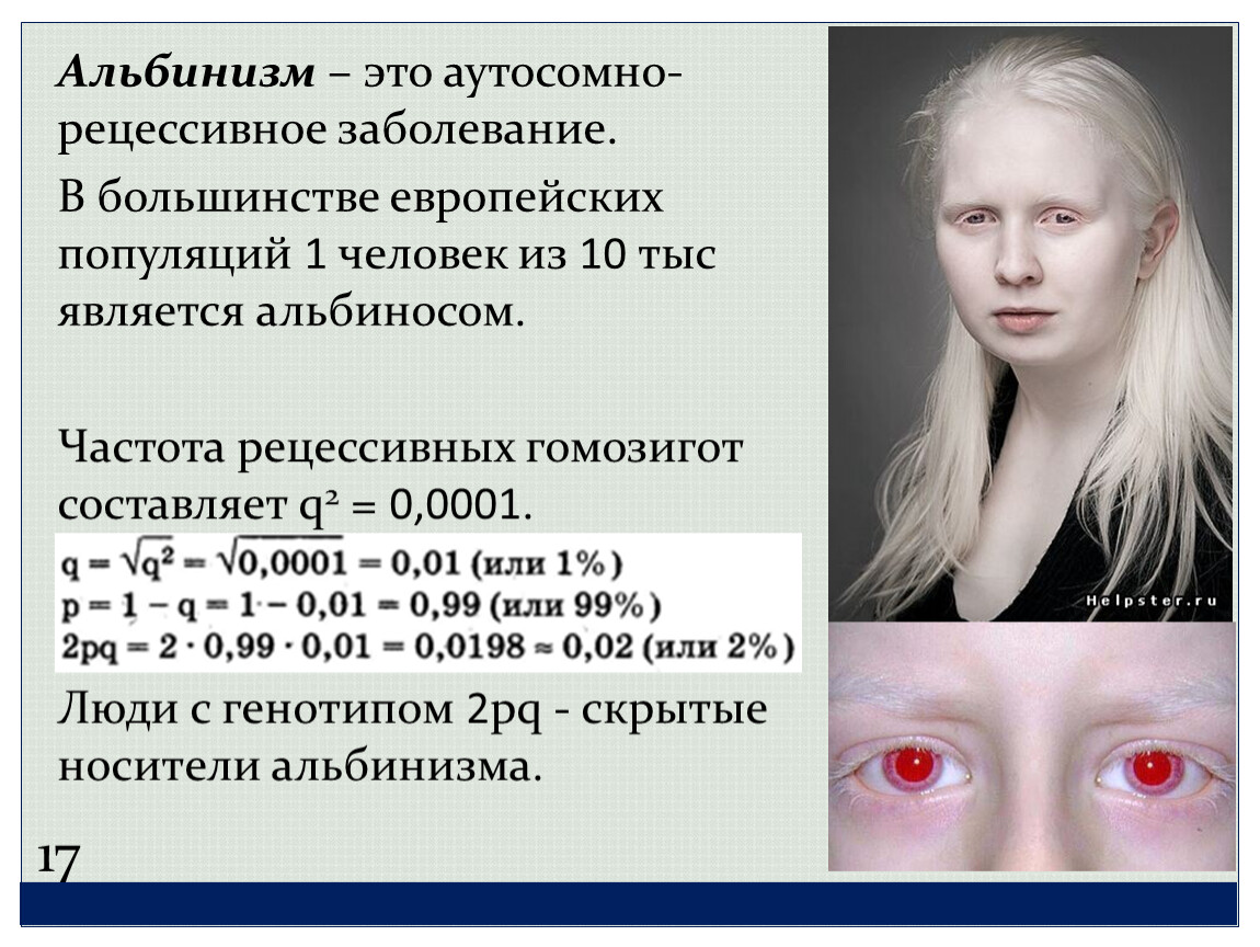 Рецессивные глаза. Генетические заболевания альбинизм. Генные болезни альбинизм. Альбинизм Тип наследования аутосомно. Альбинизм: болезнь альбиносов.