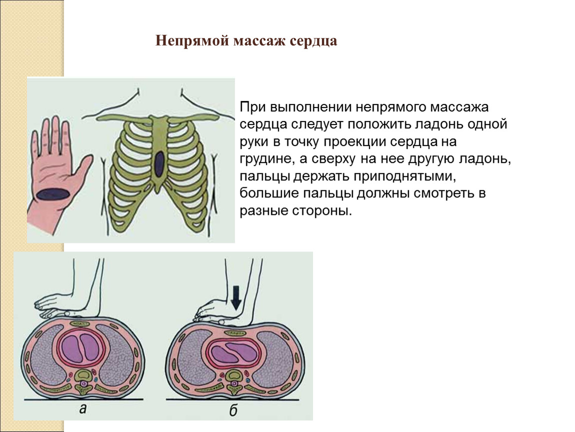 Непрямой сердца. Непрямой массаж сердца техника выполнения 1 человеком. Техника проведения непрямого массажа сердца. Наружный непрямой массаж сердца. Закрытый массаж сердца техника проведения.