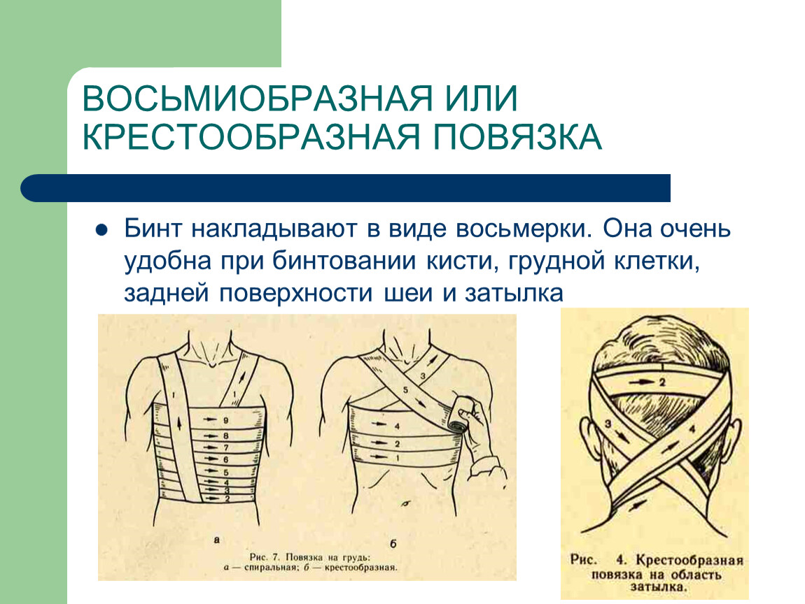 Способы наложения перевязок. Десмургия восьмиобразная повязка. Повязки при ранениях вен шеи и грудной клетки. Крестообразная (восьмиобразная) повязка. Крестообразная повязка на грудную клетку.