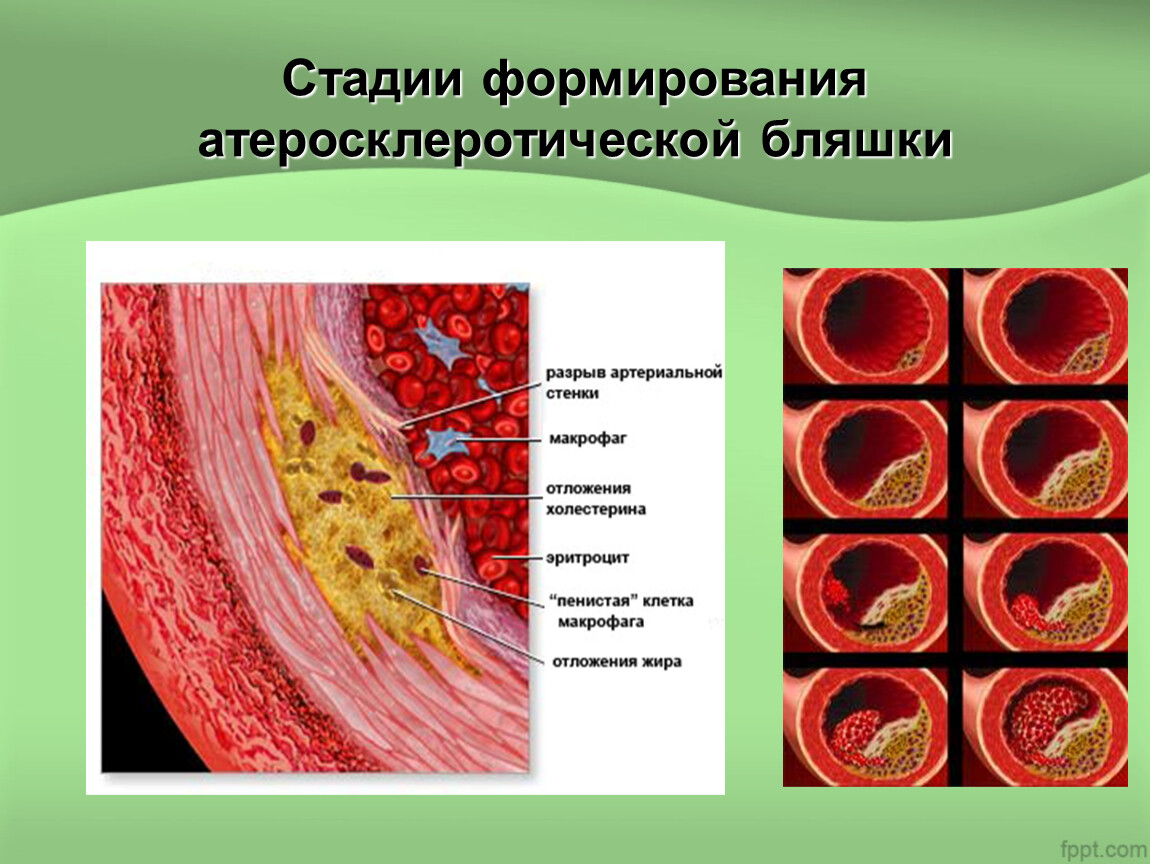 Распад сосудов. Степени атеросклероза венечных артерий. Этапы развития атеросклеротической бляшки. Этапы формирования атеросклеротической бляшки. Атеросклероз строение бляшки.