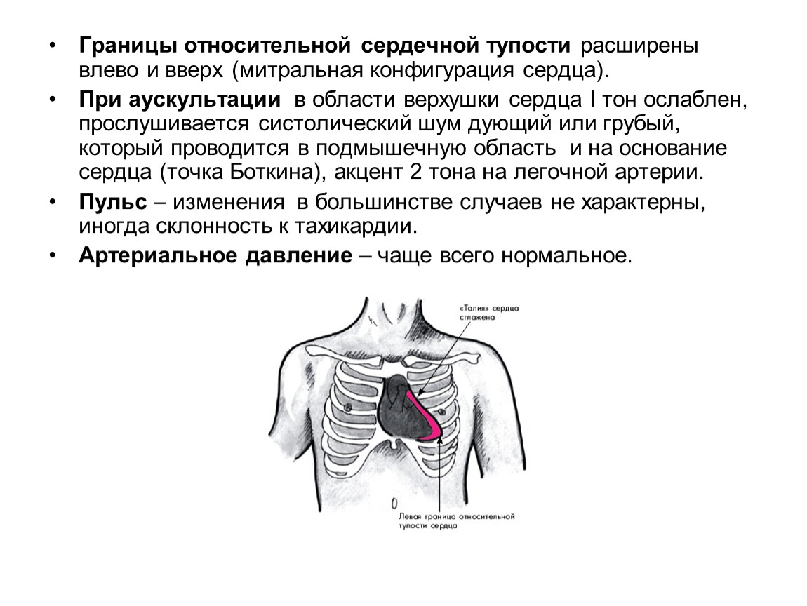 Расширение сердца влево. Расширение границы относительной тупости сердца влево. Острая ревматическая лихорадка ЭКГ. Митральная конфигурация 2. Смещение левой границы сердца влево.