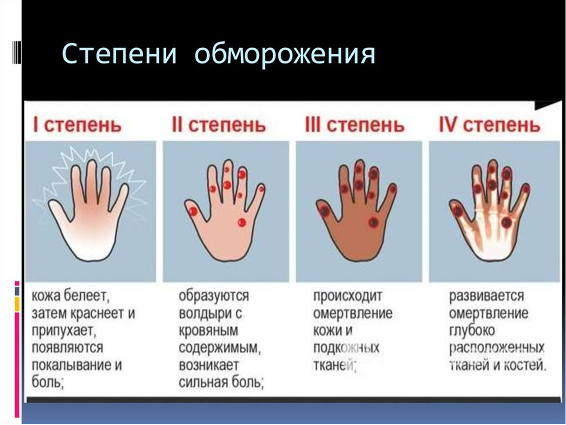 Четыре степени. Характерные признаки отморожения III степени. Отморожение конечностей 3-4 степени. Обморожение 1 2 3 степени.