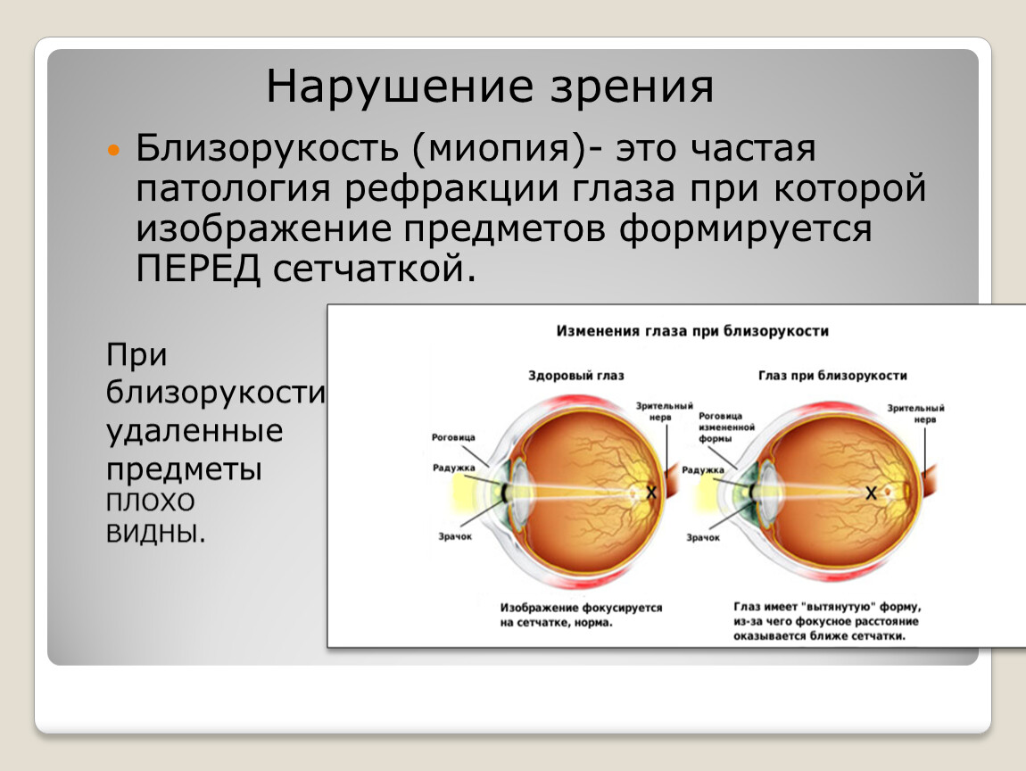 Миопия астигматизм глаз