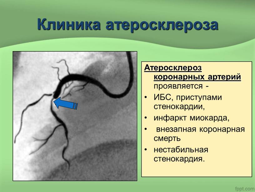 Клиника атеросклероза Атеросклероз коронарных артерий проявляется -