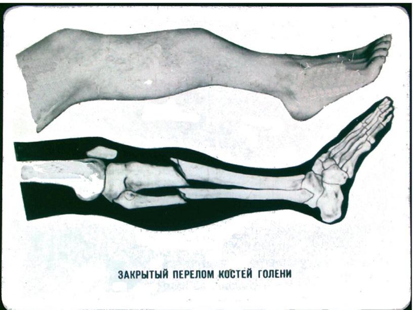 Оказание первой помощи при переломах