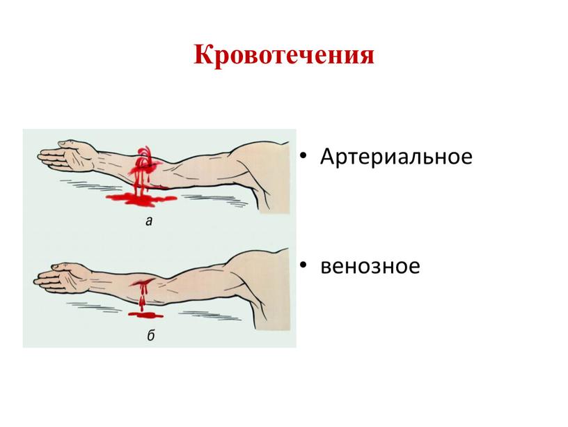 Кровотечения Артериальное венозное