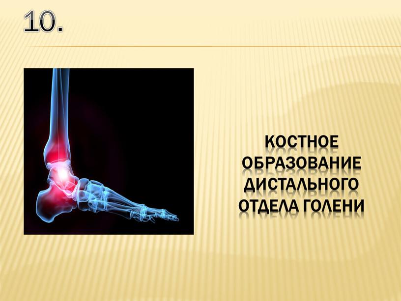 10. костное образование дистального отдела голени