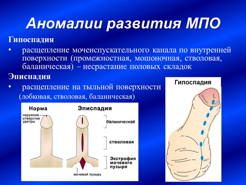 Аномалии развития МПО Гипоспадия расщепление мочеиспускательного канала по внутренней поверхности (промежностная, мошоночная, стволовая, баланическая) – несрастание половых складок