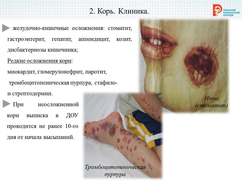 Корь. Клиника. желудочно-кишечные осложнения: стоматит, гастроэнтерит, гепатит, аппендицит, колит, дисбактериозы кишечника;