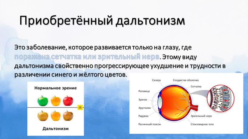 Приобретённый дальтонизм Это заболевание, которое развивается только на глазу, где поражена сетчатка или зрительный нерв