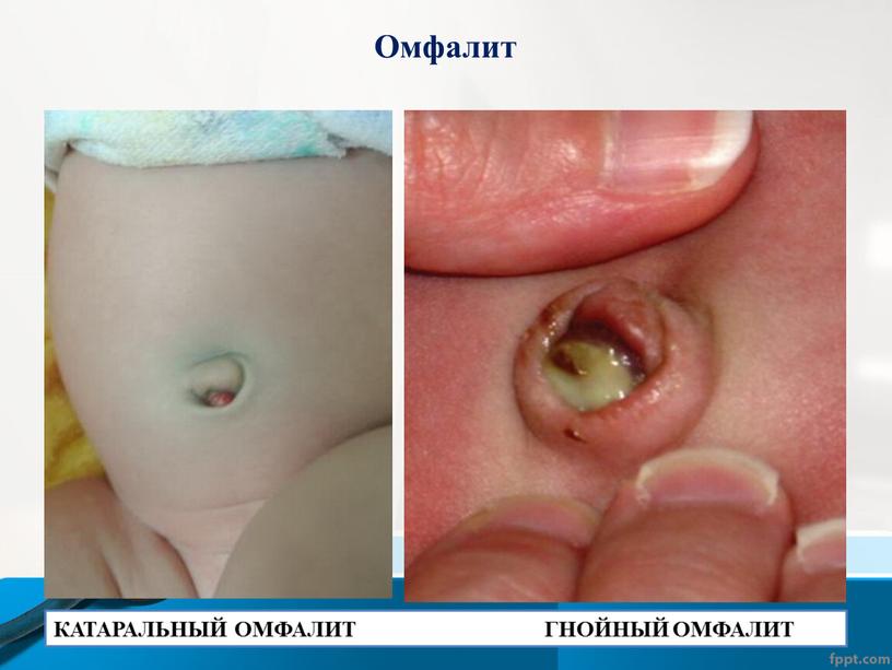 Омфалит КАТАРАЛЬНЫЙ ОМФАЛИТ