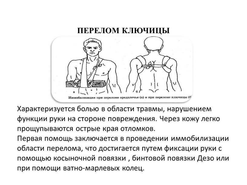 ПЕРЕЛОМ КЛЮЧИЦЫ Характеризуется болью в области травмы, нарушением функции руки на стороне повреждения