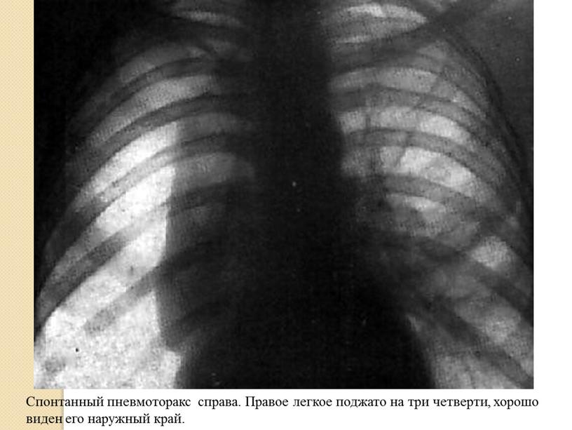 Спонтанный пневмоторакс справа