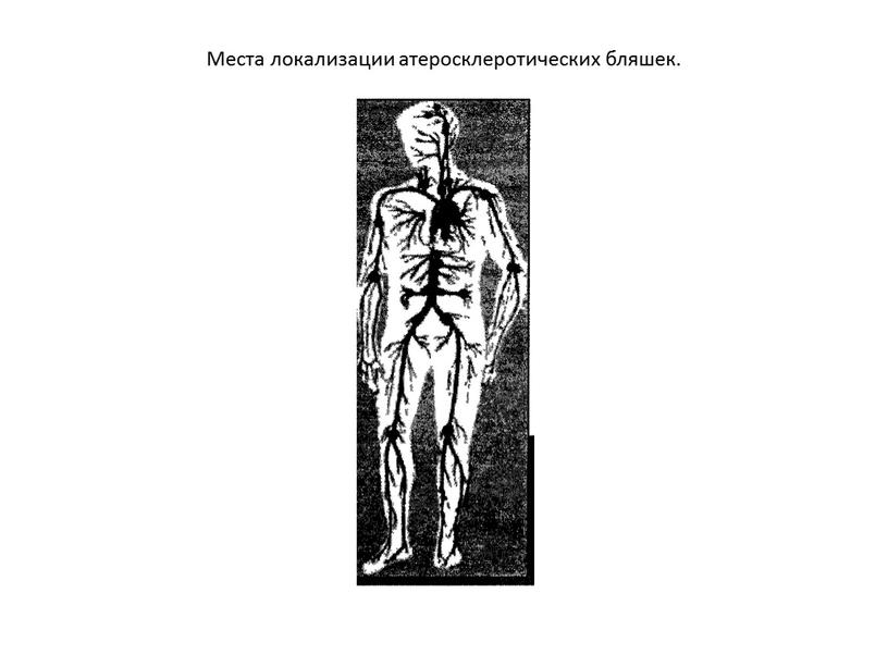 Места локализации атеросклеротических бляшек