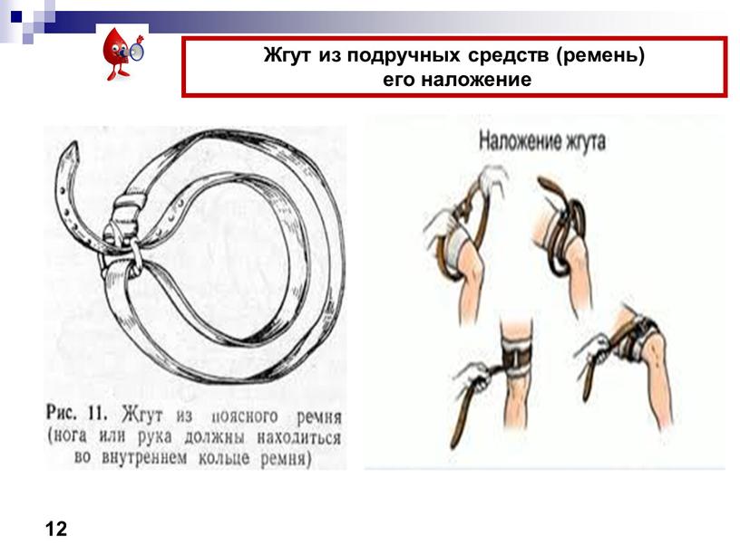 Жгут из подручных средств (ремень) его наложение 12