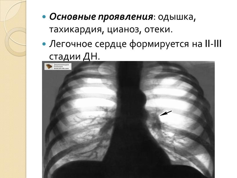 Основные проявления : одышка, тахикардия, цианоз, отеки