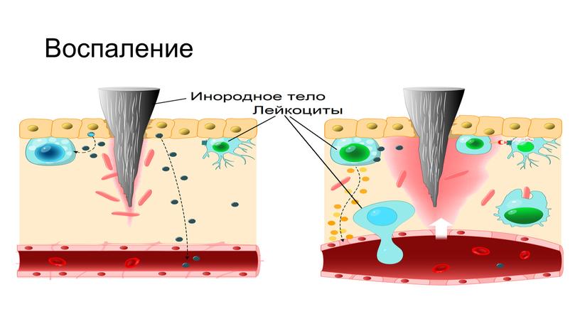 Воспаление